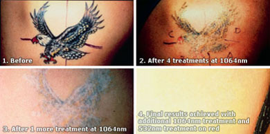 Itchy Tattoo: Why It Happens and How to Find Relief